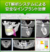CT解析システムによる安全なインプラント治療